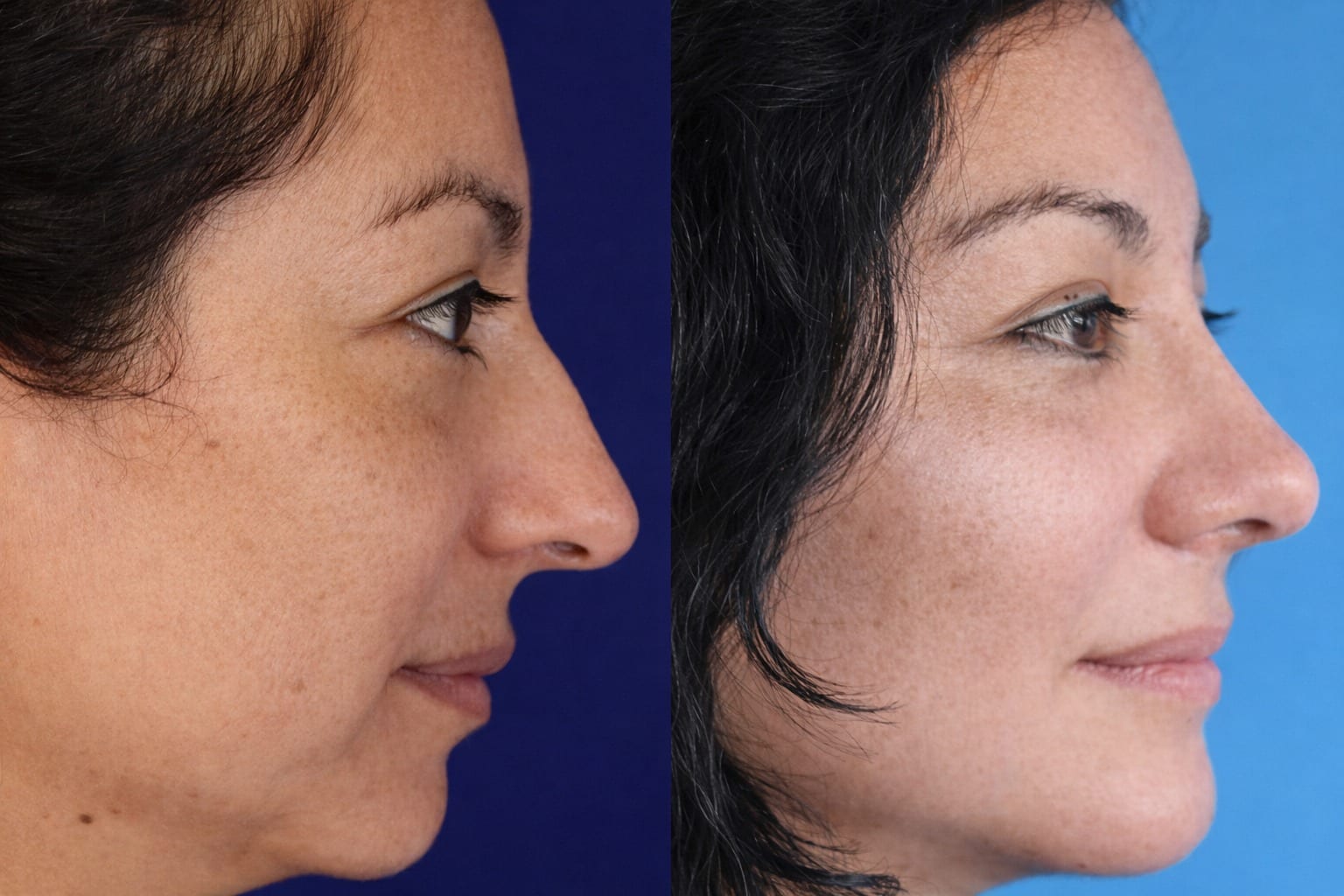 Rinoplastia caso 18 — antes y después